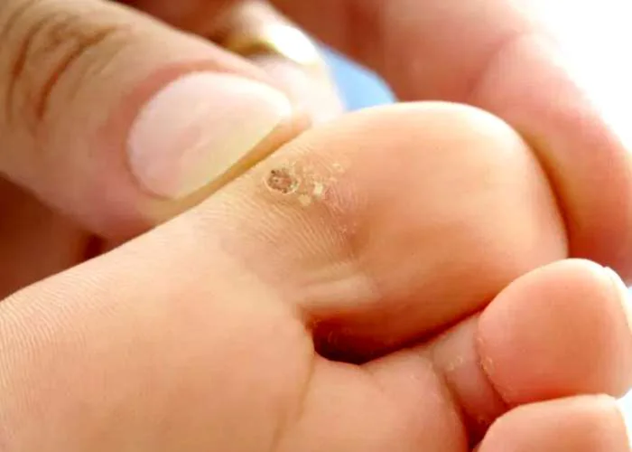 Verruga plantar visível na região do dedo do pé